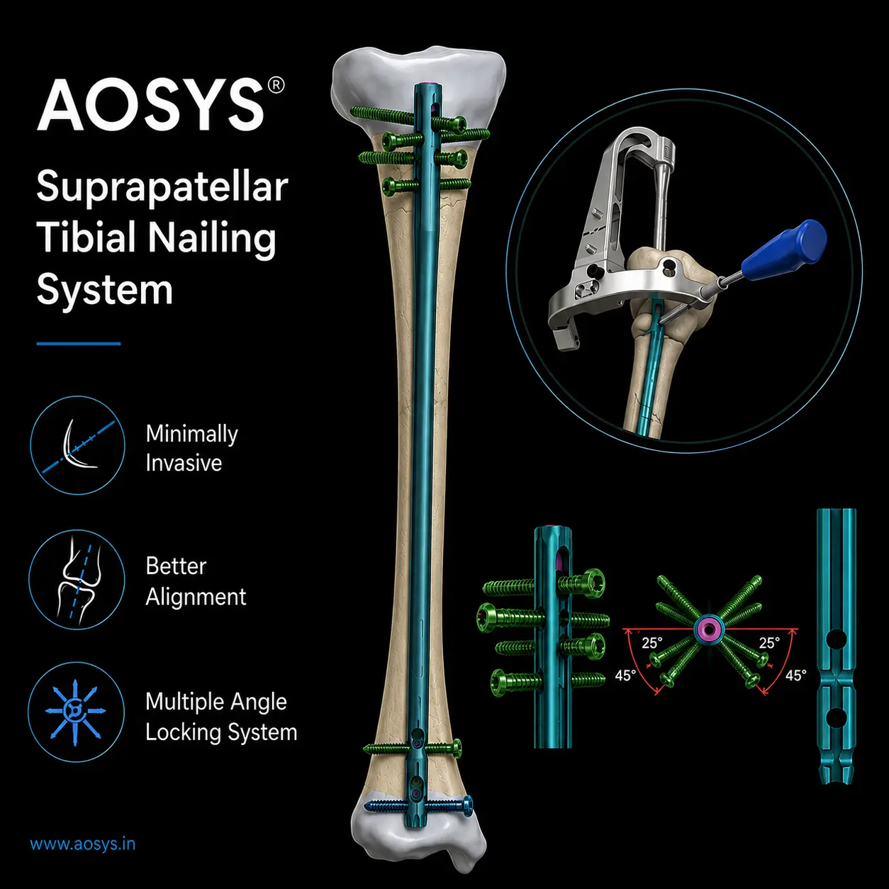 Suprapatellar Tibial Nailing System