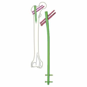 Proximal Femoral Interlocking Nail