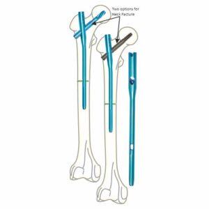 Proximal Femoral Interlocking Nail Antirotation